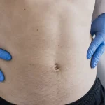 Cretes iliaques : repère L4, palpation des douleurs