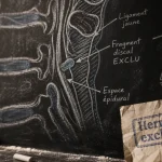 Hernie discale exclue vue IRM : résorption en quelques mois
